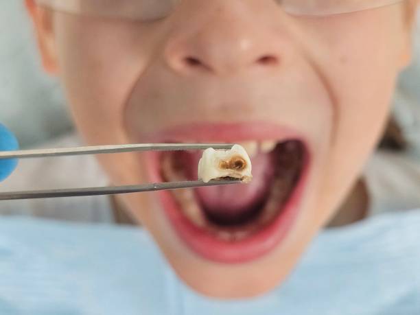 Best Emergency Wisdom Teeth Removal in De Pue, IL